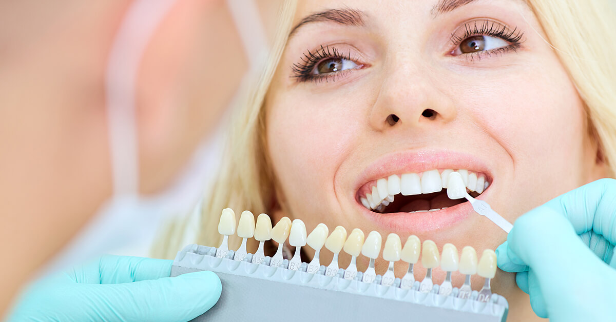 Tooth crowns and teeth veneers to whiten teeth in Kelowna