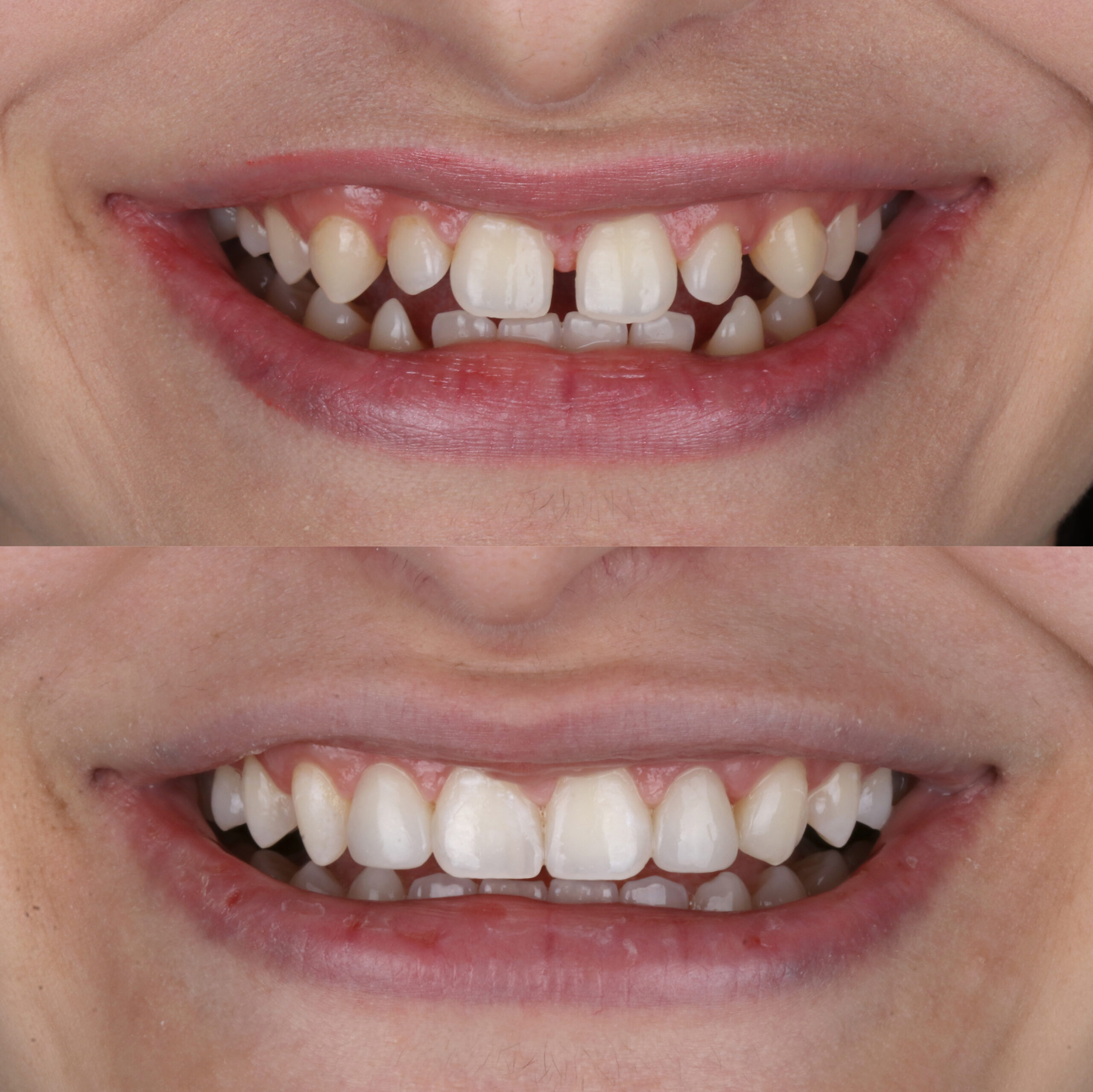 Before and after composite dental bonding to fill gaps and reshape teeth